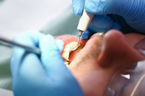 Best Dentist for Tooth Abscess  in Rossville, IN